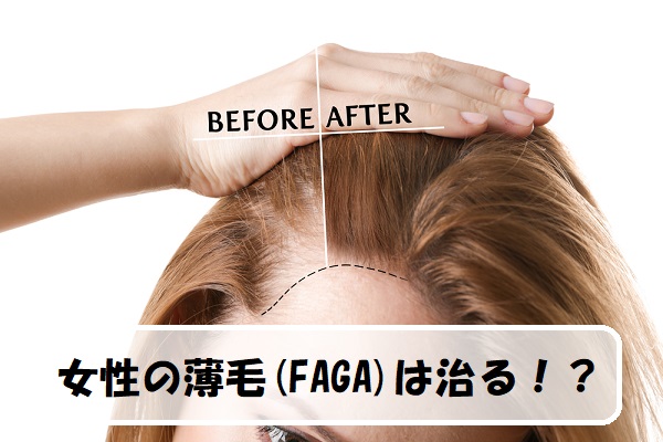 女性の薄毛【FAGA】は治る？原因と対策方法まとめ！